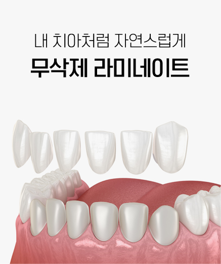 무삭제 라미네이트