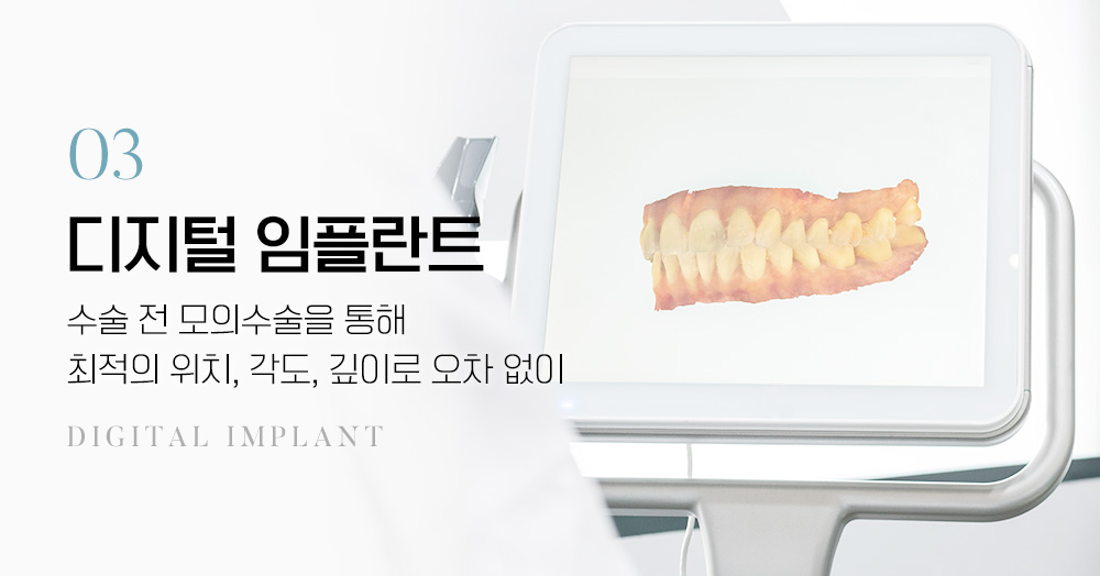 디지털 임플란트:수술 전 모의수술을 통해 최적의 위치, 각도, 깊이로 오차 없이